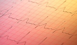Close-up of an electrocardiogram (ECG) tracing on graph paper, showing heart rhythm waveforms across the page.
